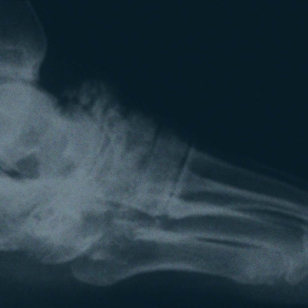 Fractured Futures: Teen Sports and Overuse Injury